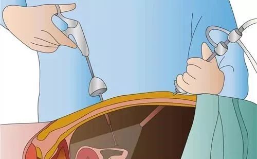 蓝色宝贝小科普:取卵方法「疼痛指数排行榜」